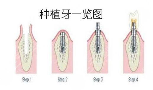 Sharing of dental implant process in Chengdu Xinqiao Dental Hospital