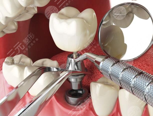 Sharing of dental implant process in Chengdu Xinqiao Dental Hospital